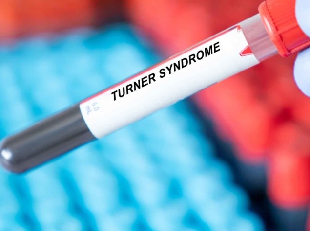 Fiala di sangue con etichetta con scritto "Turner Syndrome"