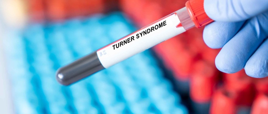 Fiala di sangue con etichetta con scritto "Turner Syndrome"