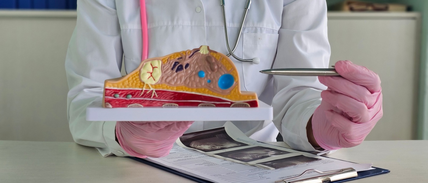 Un medico che mostra un tumore o un cancro al seno su un modello anatomico del seno per educare le donne sulla prevenzione e il trattamento delle malattie del seno