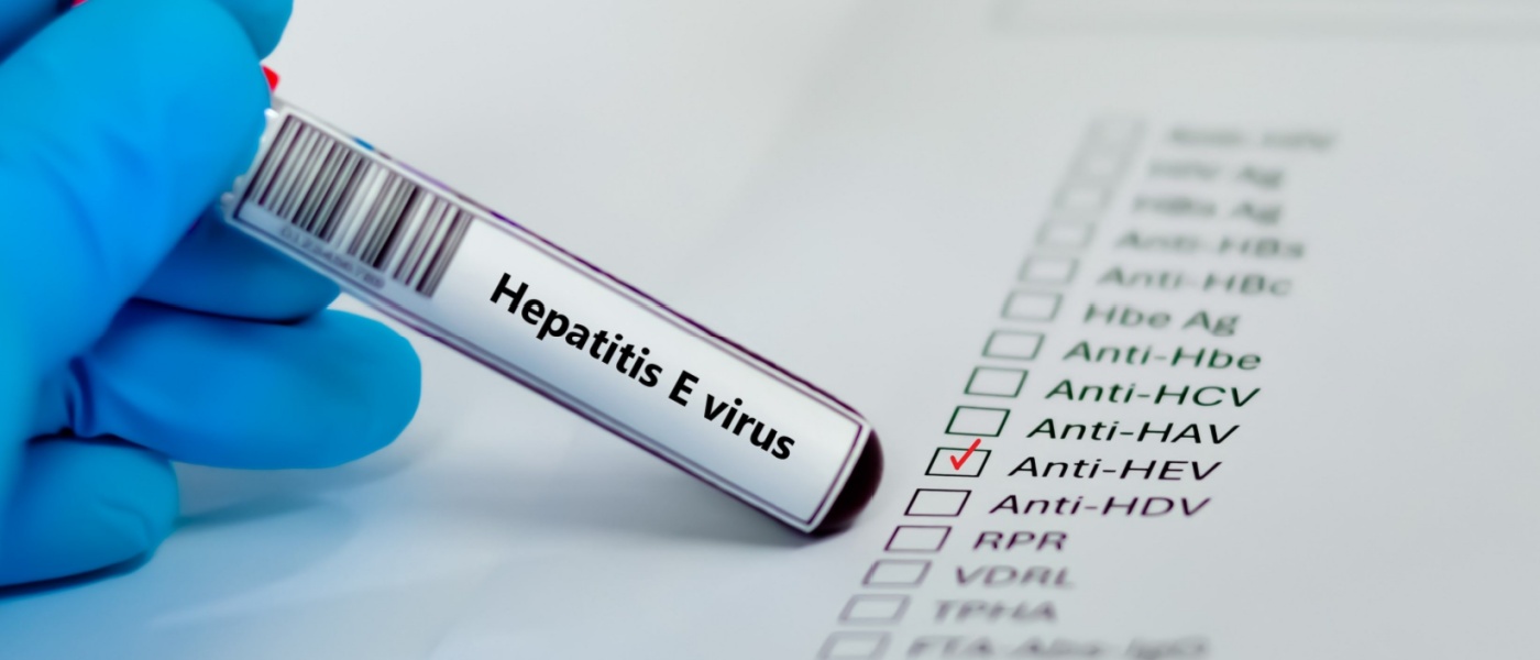 epatite E