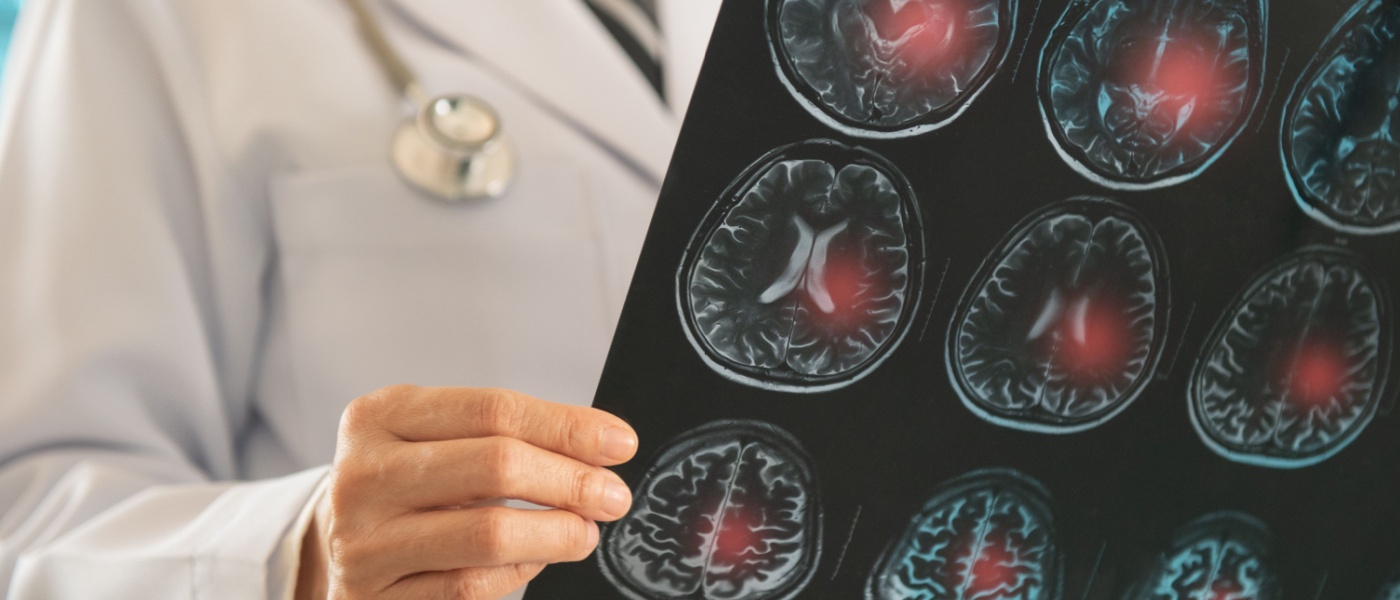 Medico radiologia osserva lastra per la diagnosi di ictus ischemico