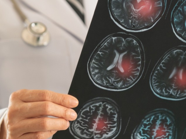 Medico radiologia osserva lastra per la diagnosi di ictus ischemico