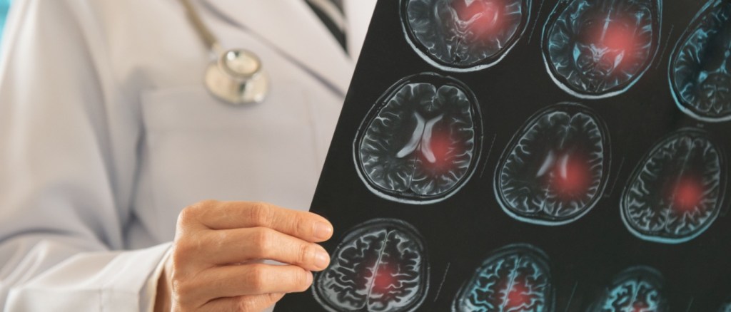 Medico radiologia osserva lastra per la diagnosi di ictus ischemico