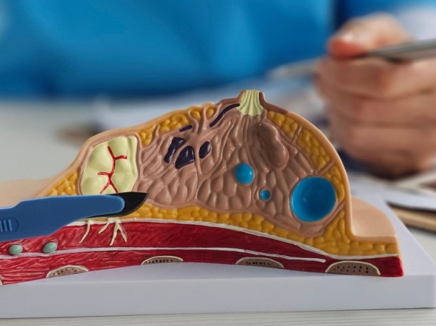 Rimozione del tumore al seno e oncologia