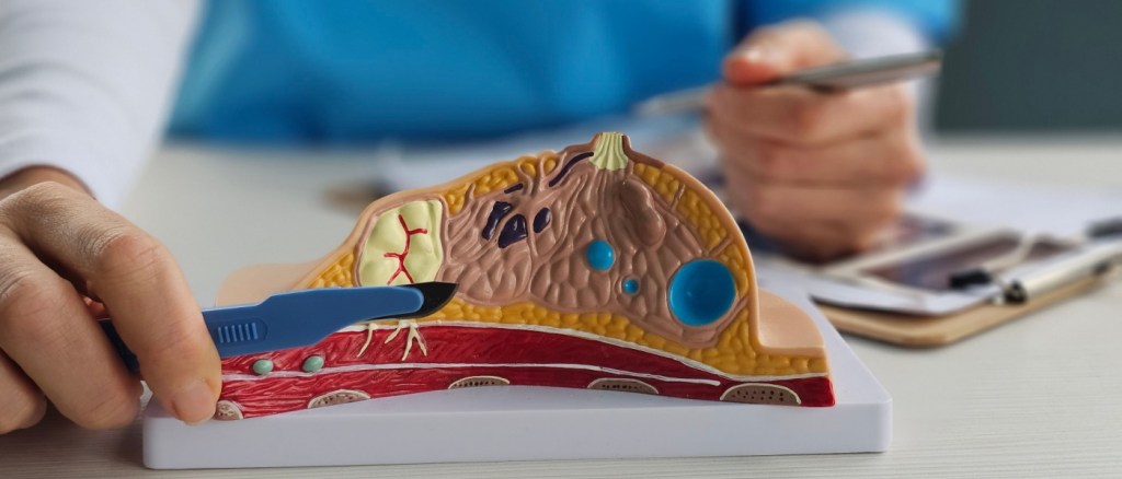 Rimozione del tumore al seno e oncologia