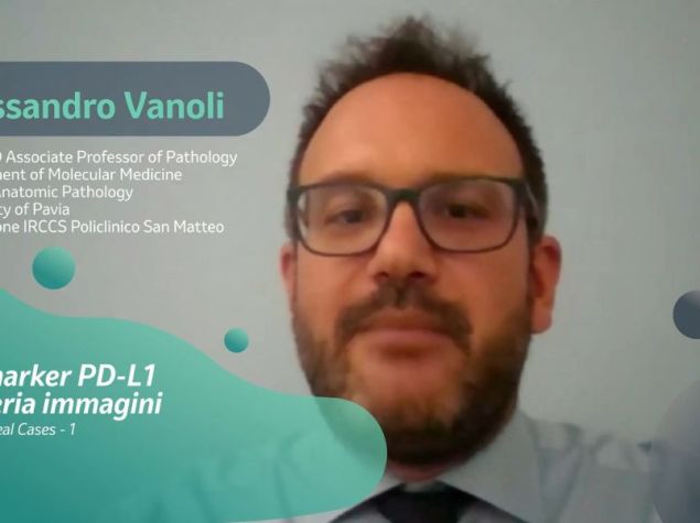 Prof Alessandro Vanoli, utilizza Image Bank di MSD Salute per analizzare il vetrino con il caso di carcinoma squamocellulare esofageo moderatamente differenziato, con presenza di infiltrato infiammatorio nello stroma cellulare.