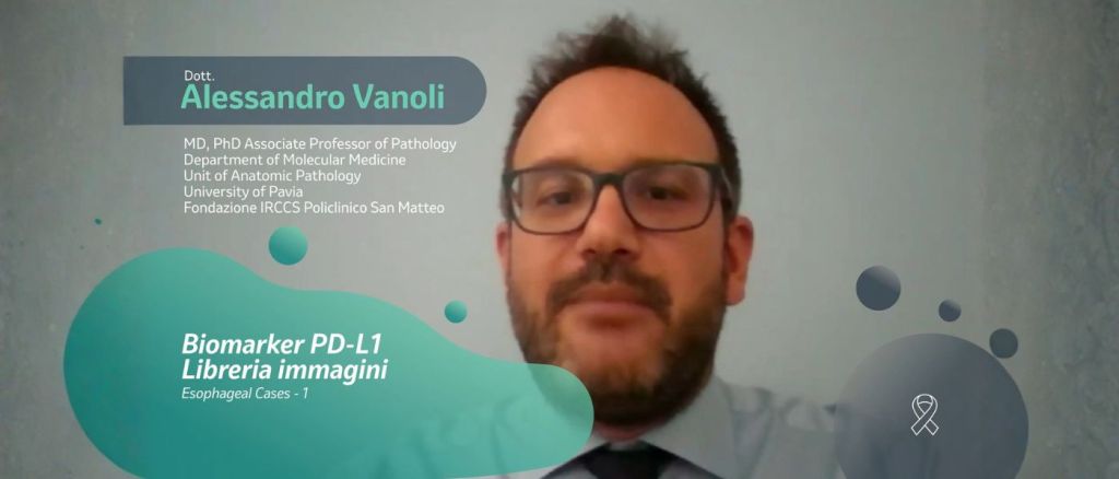 Prof Alessandro Vanoli, utilizza Image Bank di MSD Salute per analizzare il vetrino con il caso di carcinoma squamocellulare esofageo moderatamente differenziato, con presenza di infiltrato infiammatorio nello stroma cellulare.