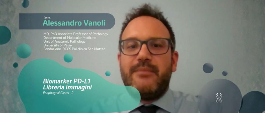 Prof Alessandro Vanoli , utilizzando lo strumento Image Bank di MSD Salute analizza il vetrino del caso; carcinoma squamocellulare con presenza di ulcerazione e componente displastica squamosa preinvasiva associata alla componente infiltrante