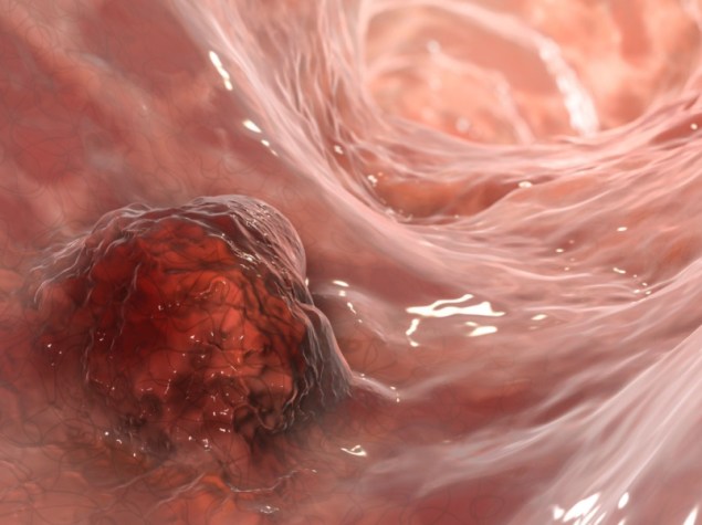 illustrazione 3D che mostra un tumore maligno nell'intestino