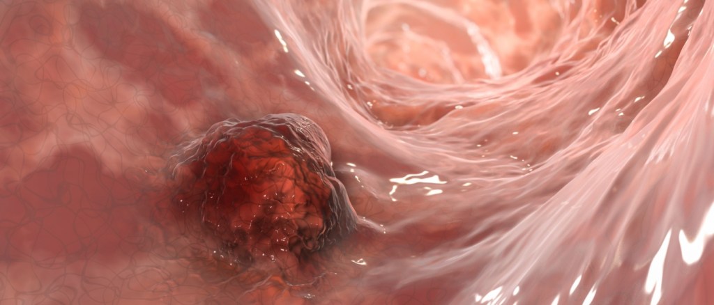 illustrazione 3D che mostra un tumore maligno nell'intestino