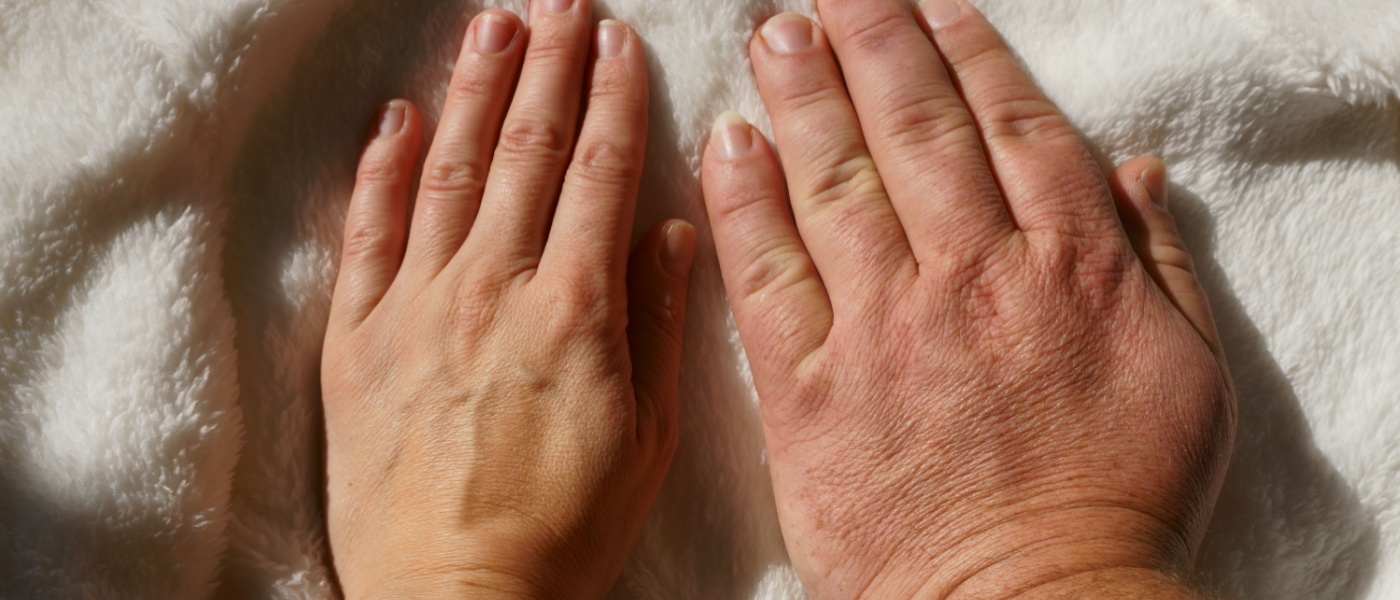 acromegalia medicina mano persone dito