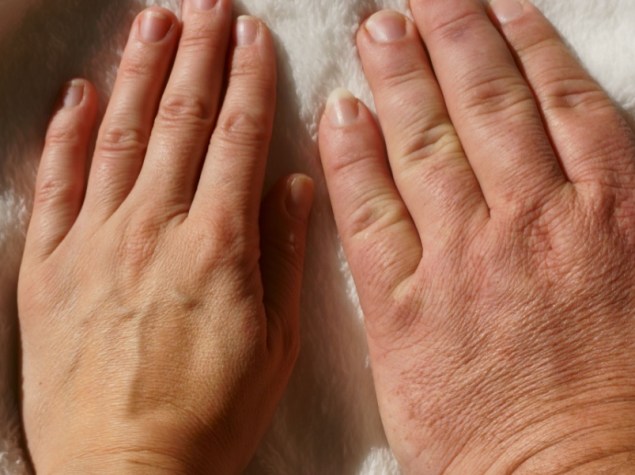 acromegalia medicina mano persone dito