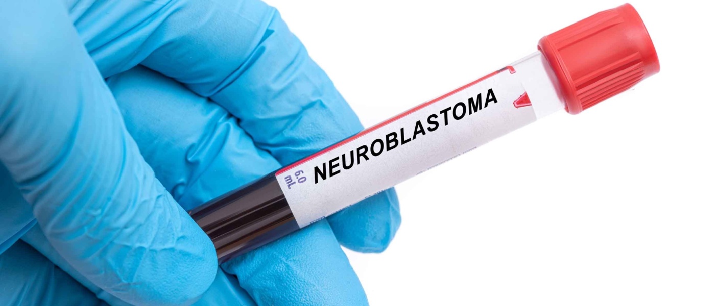 Provetta di sangue per la malattia del neuroblastoma nella mano di un medico
