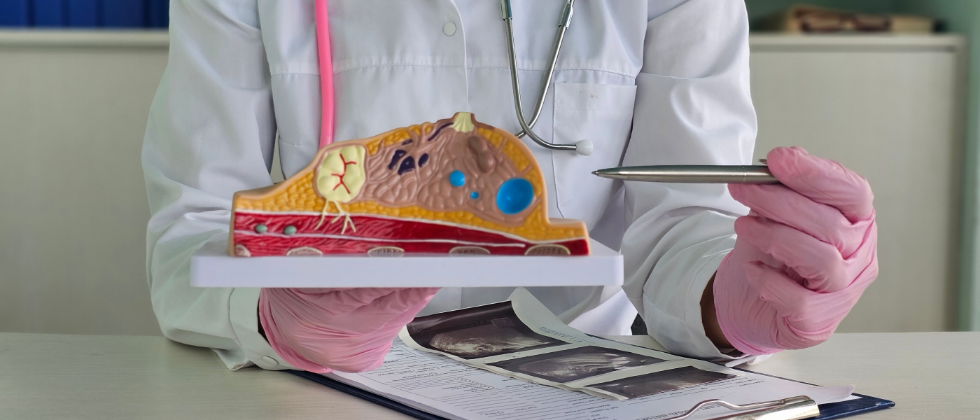 un dottore mostra un modello di seno con tumore