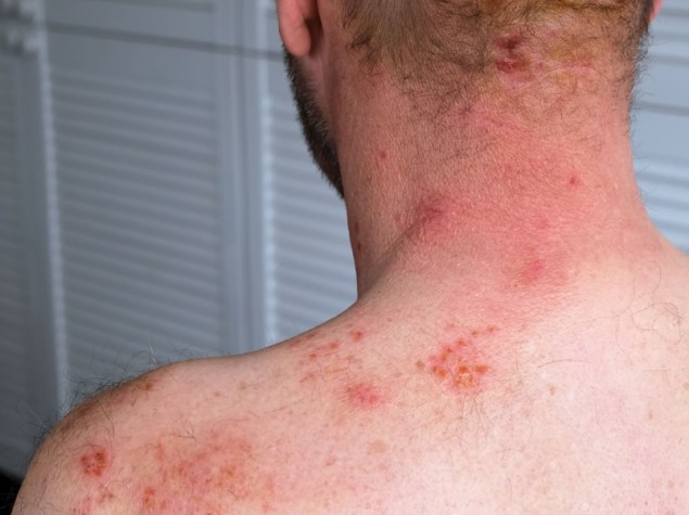 Herpes Zoster