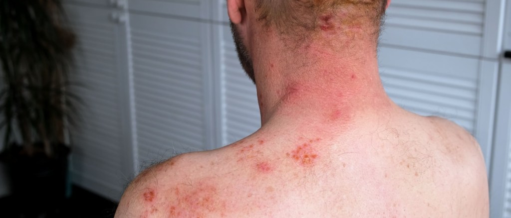 Herpes Zoster