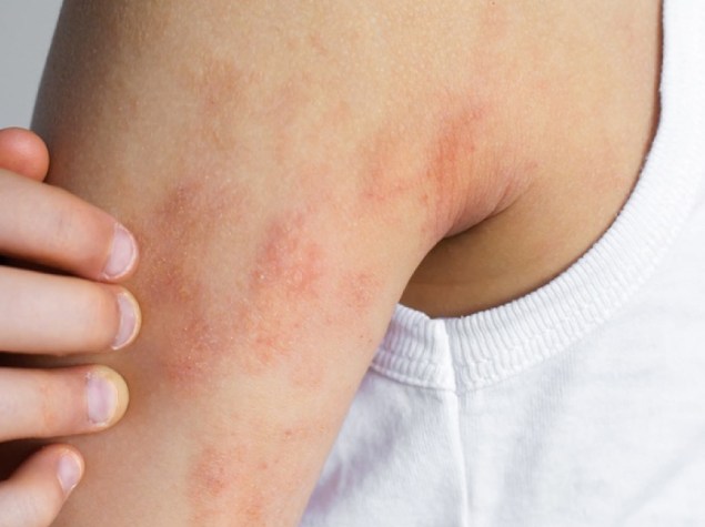 Grattamento del gomito irritato del bambino con sintomi visibili di eczema della dermatite atopica, macchie rosse secche sulla pelle sensibile,