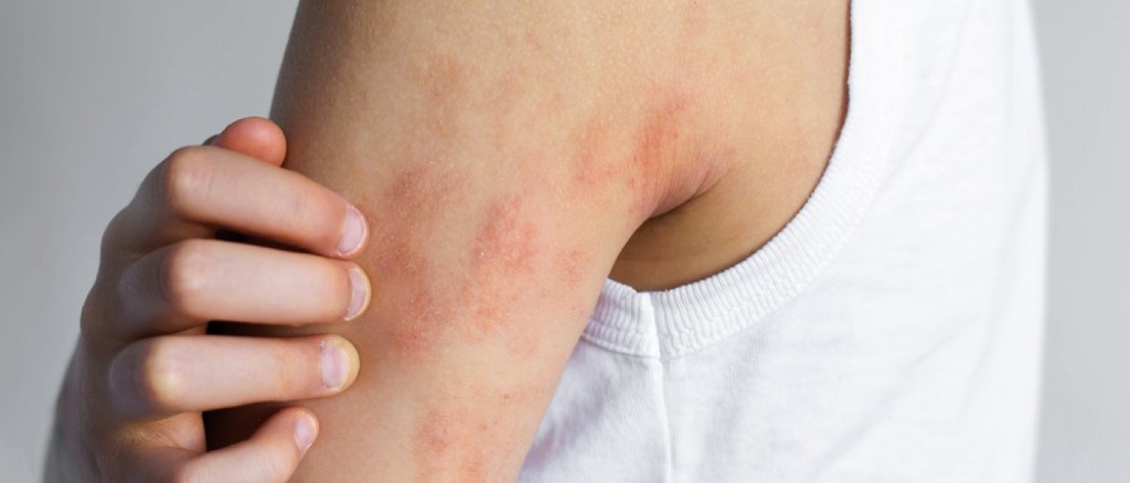 Grattamento del gomito irritato del bambino con sintomi visibili di eczema della dermatite atopica, macchie rosse secche sulla pelle sensibile,
