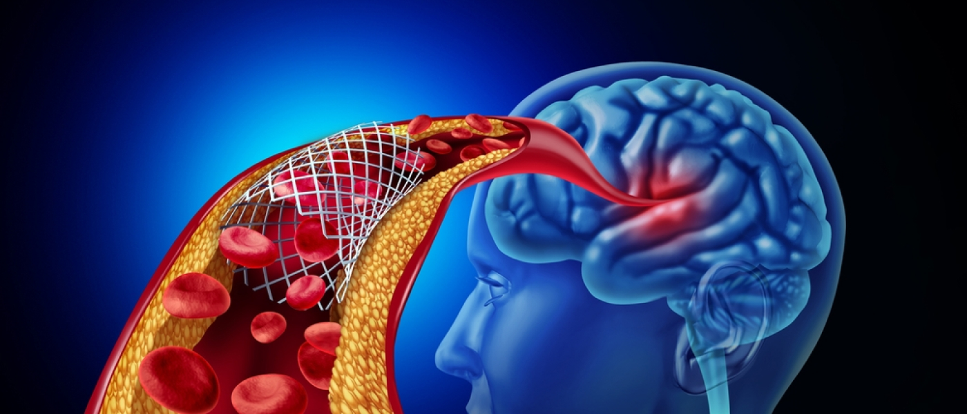 Stenting For Brain or neurovascular stents and cerebral angioplasty to maintain blood flow in a blocked blood vessel as a medical illustration concept.