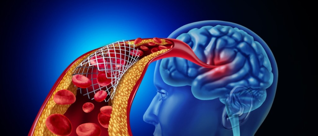 Stenting For Brain or neurovascular stents and cerebral angioplasty to maintain blood flow in a blocked blood vessel as a medical illustration concept.